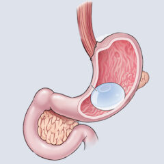 Mide Balonu Uygulama Aşamaları